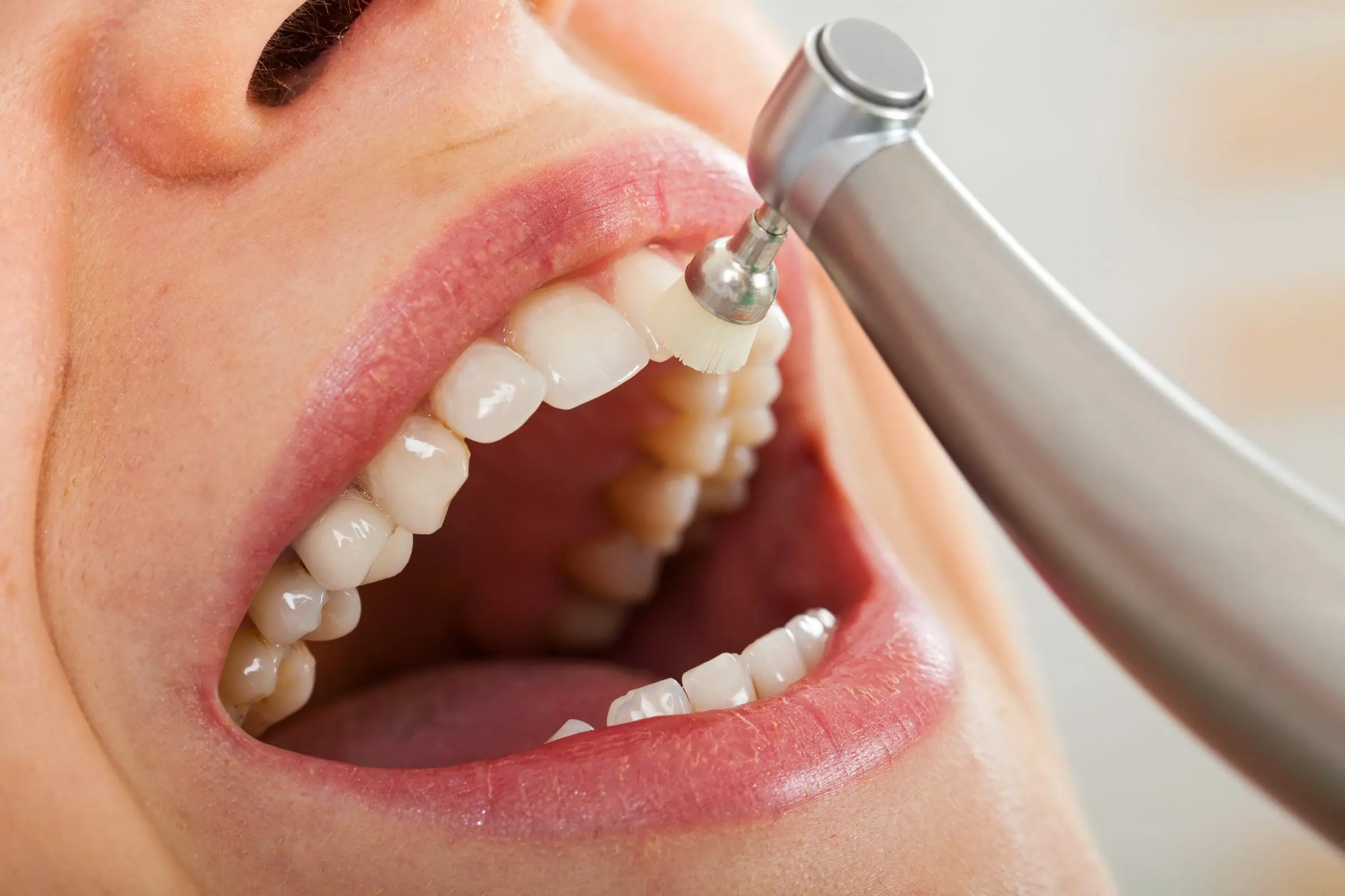 Advanced Teeth Cleaning and Polishing