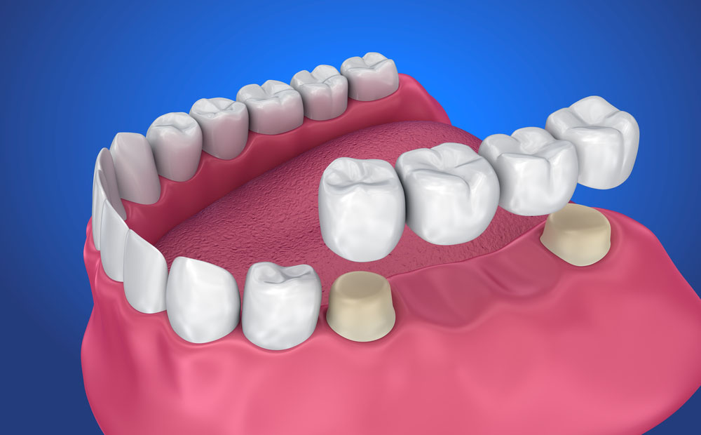 High-Quality Dental Crowns and Bridges