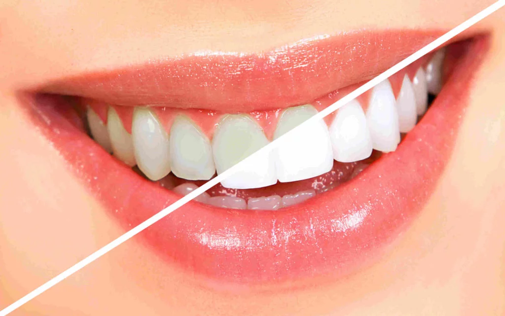 Professional Teeth Whitening for a Brighter Smile